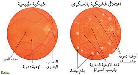 تكنولوجيا ذكاء اصطناعي لفحص اعتلال الشبكية السكري